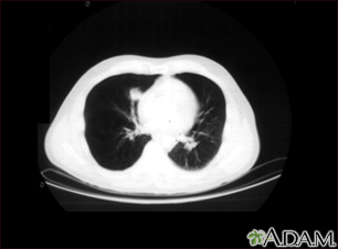 Lung nodule, right lower lung - CT scan