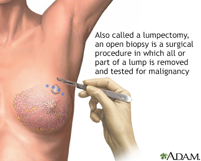 Open biopsy of the breast