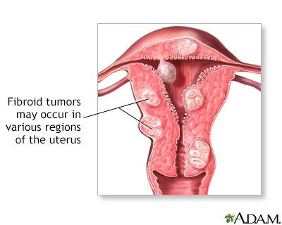 Fibroid tumors