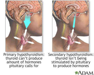 Primary and secondary hypothyroidism