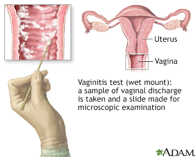 The wet mount vaginitis test