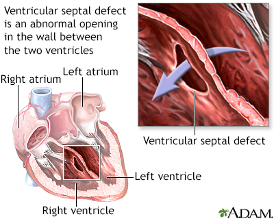 Ventricular septal defect