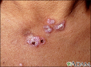Lupus, discoid  - view of lesions on the chest
