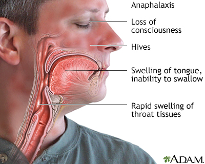 Allergic reaction swelling in neck