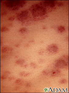 Acute monocytic leukemia - skin