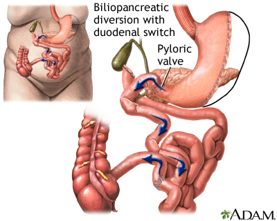 Biliopancreatic diversion with duodenal switch