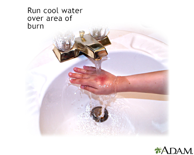 Minor burn treatment - run under cool water