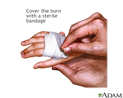 Minor burn treatment - apply bandage