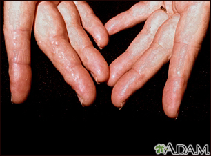 Amyloidosis of the fingers