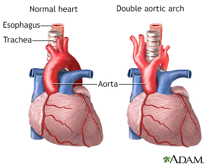 Double aortic arch