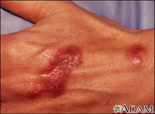 Mycobacterium marinum infection on the hand