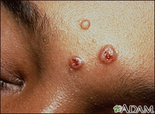 Cryptococcosis on the forehead