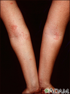 Dermatitis - atopic on the arms
