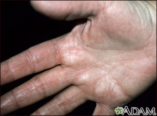 Hyperlinearity in atopic dermatitis - on the palm