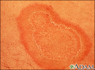 Erythema annulare centrifugum - close-up