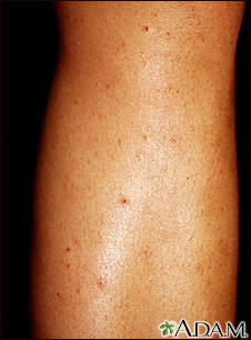 Folliculitis on the leg
