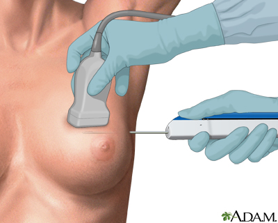 Core needle biopsy of the breast