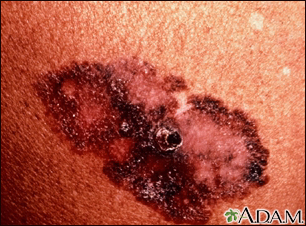 Skin cancer - melanoma superficial spreading