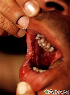 Pemphigus vulgaris - lesions in the mouth