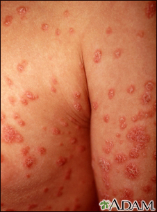 Psoriasis - guttate on the arms and chest