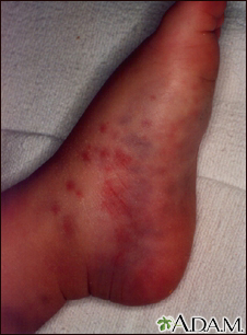 Henoch-Schonlein purpura on an infant's foot