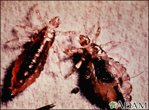Lice, body with stool (Pediculus humanus)