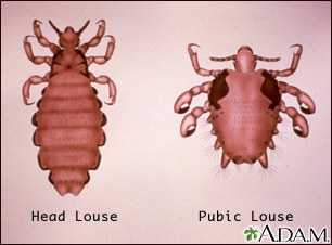 Head louse and pubic louse