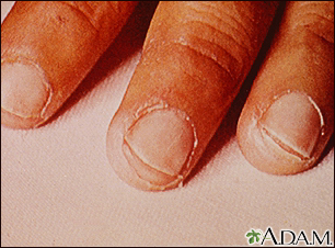 Kawasaki's disease - peeling of the fingertips