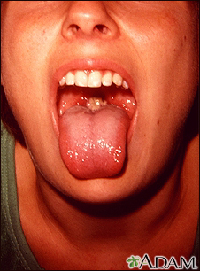 Mononucleosis - mouth