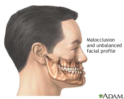 Malocclusion of teeth