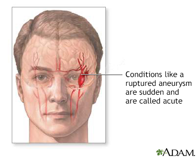 Ruptured intracranial aneurysm