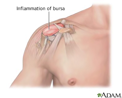 Bursitis of the shoulder