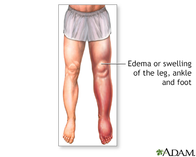 Lower leg edema