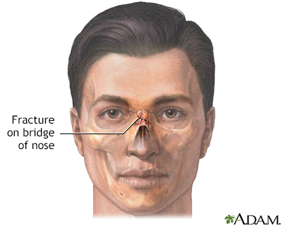 Nasal fracture