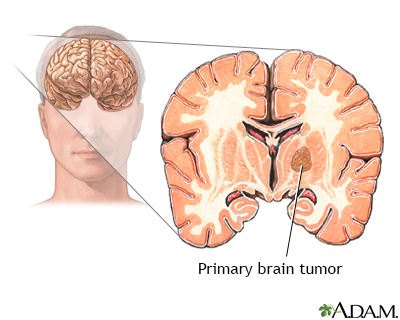 Primary brain tumor