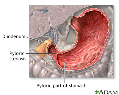 Pyloric stenosis