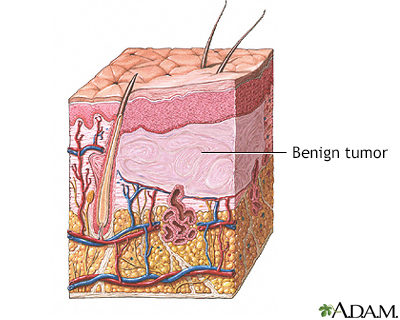 Benign tumor of the skin