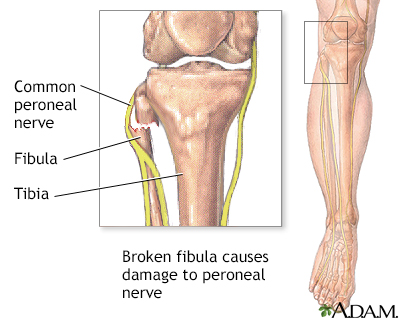 Common peroneal nerve dysfunction