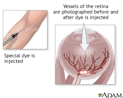 Retinal dye injection