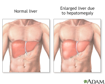 Hepatomegaly