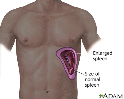Enlarged spleen