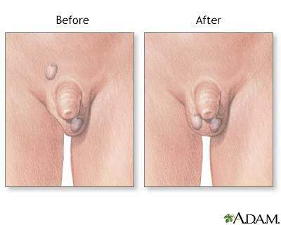 Before and after testicular repair