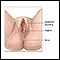 Anterior vaginal wall repair (surgical treatment of urinary incontinence) - series