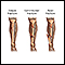 Bone fracture repair - series