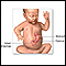 Infantile pyloric stenosis - series