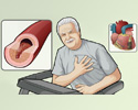 Coronary artery disease (CAD) overview