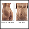 Liposuction - series - Indications