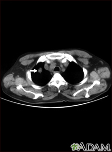 Pulmonary nodule, solitary - CT scan