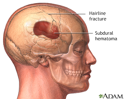 Skull fracture headache location diagram 