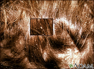 HIE Multimedia - Head lice